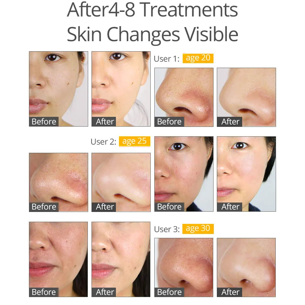 Professional Diamond Microdermabrasion Machine For Facial Peeling Skin Care Blackhead Removel Water Spray Exfoliation Machine 07